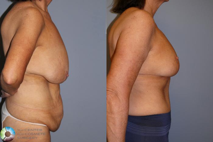 Before & After Mommy Makeover Case 11936 Right Side in Denver and Colorado Springs, CO