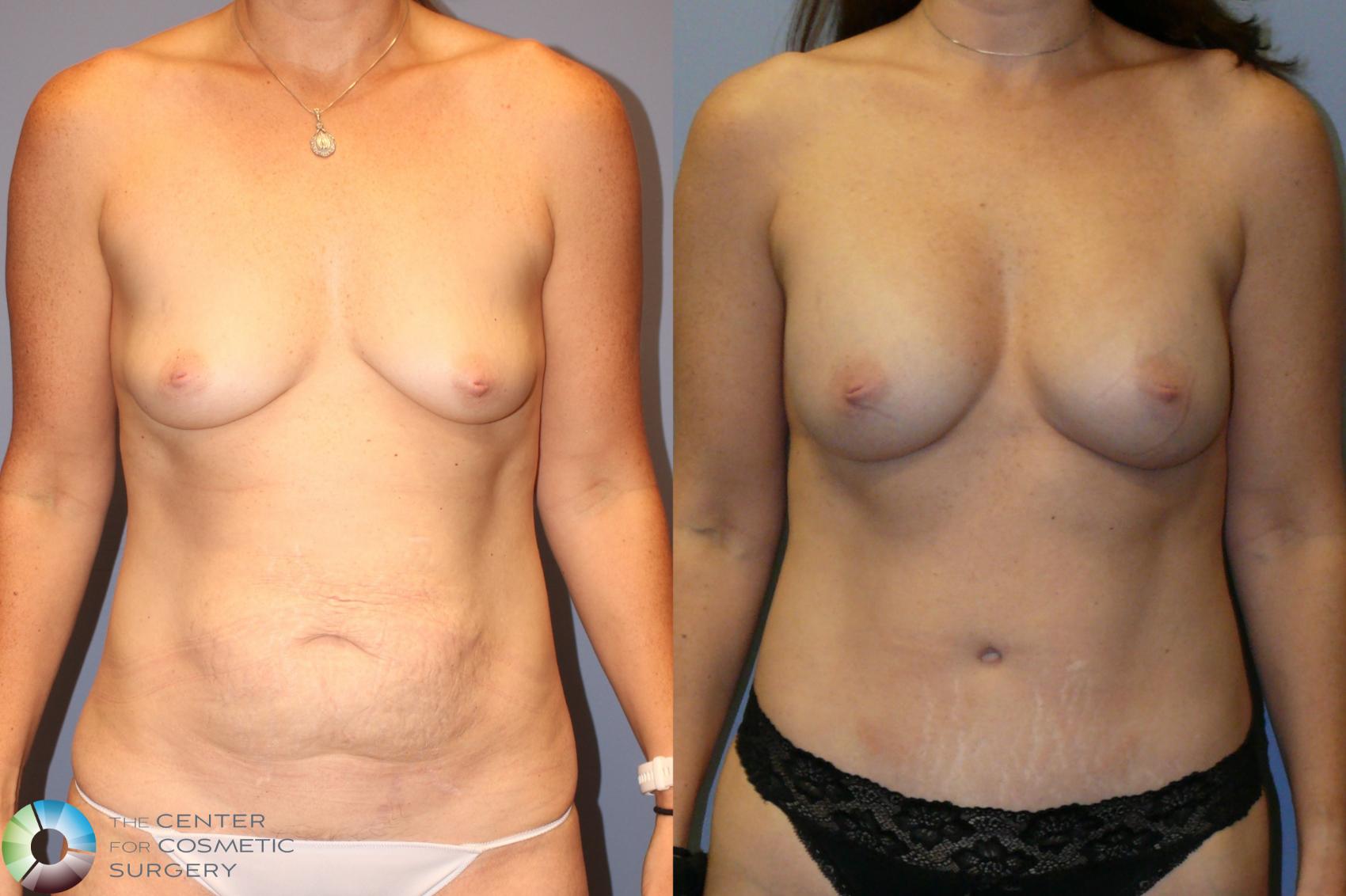 Before & After Mommy Makeover Case 11937 Front in Denver and Colorado Springs, CO