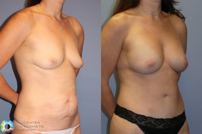 Before & After Mommy Makeover Case 11937 Right Oblique in Denver and Colorado Springs, CO