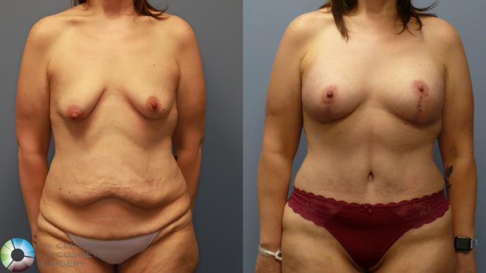 Before & After Tummy Tuck Case 11946 Front in Denver and Colorado Springs, CO