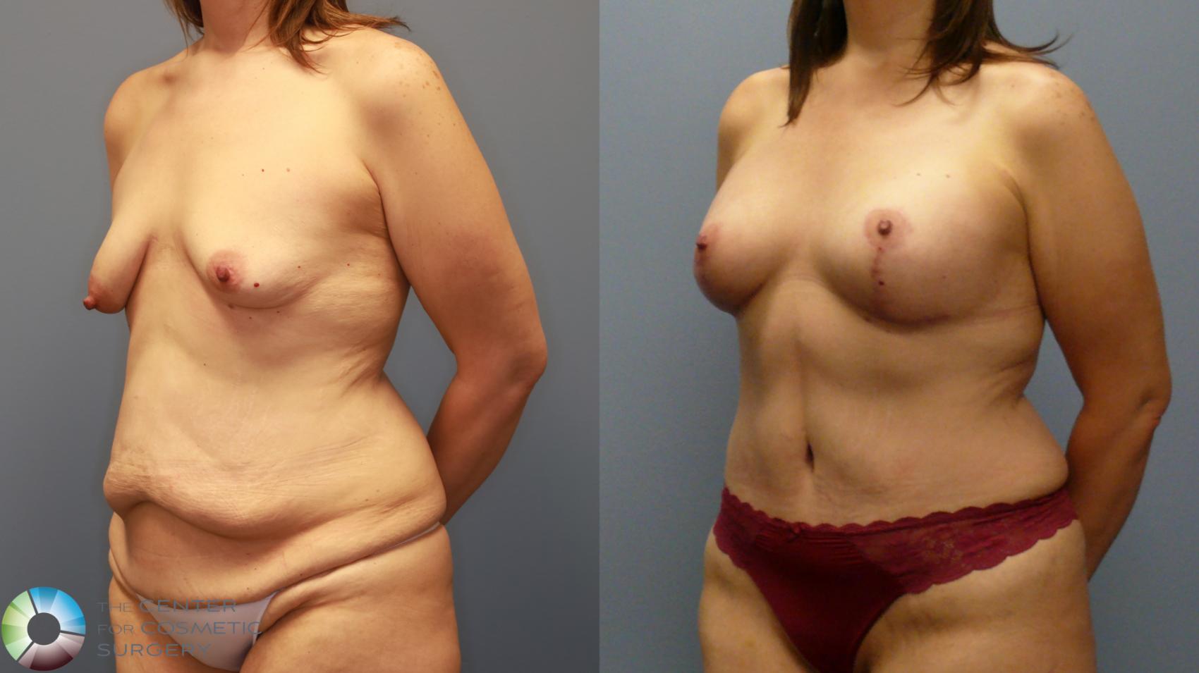 Before & After Mommy Makeover Case 11946 Left Oblique in Denver and Colorado Springs, CO