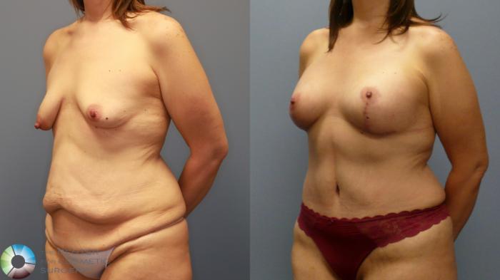 Before & After Tummy Tuck Case 11946 Left Oblique in Denver and Colorado Springs, CO