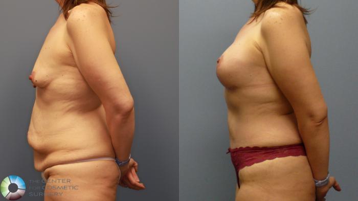 Before & After Tummy Tuck Case 11946 Left Side in Denver and Colorado Springs, CO