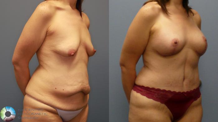 Before & After Mommy Makeover Case 11946 Right Oblique in Denver and Colorado Springs, CO