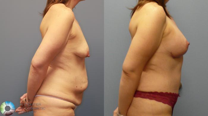 Before & After Mommy Makeover Case 11946 Right Side in Denver and Colorado Springs, CO