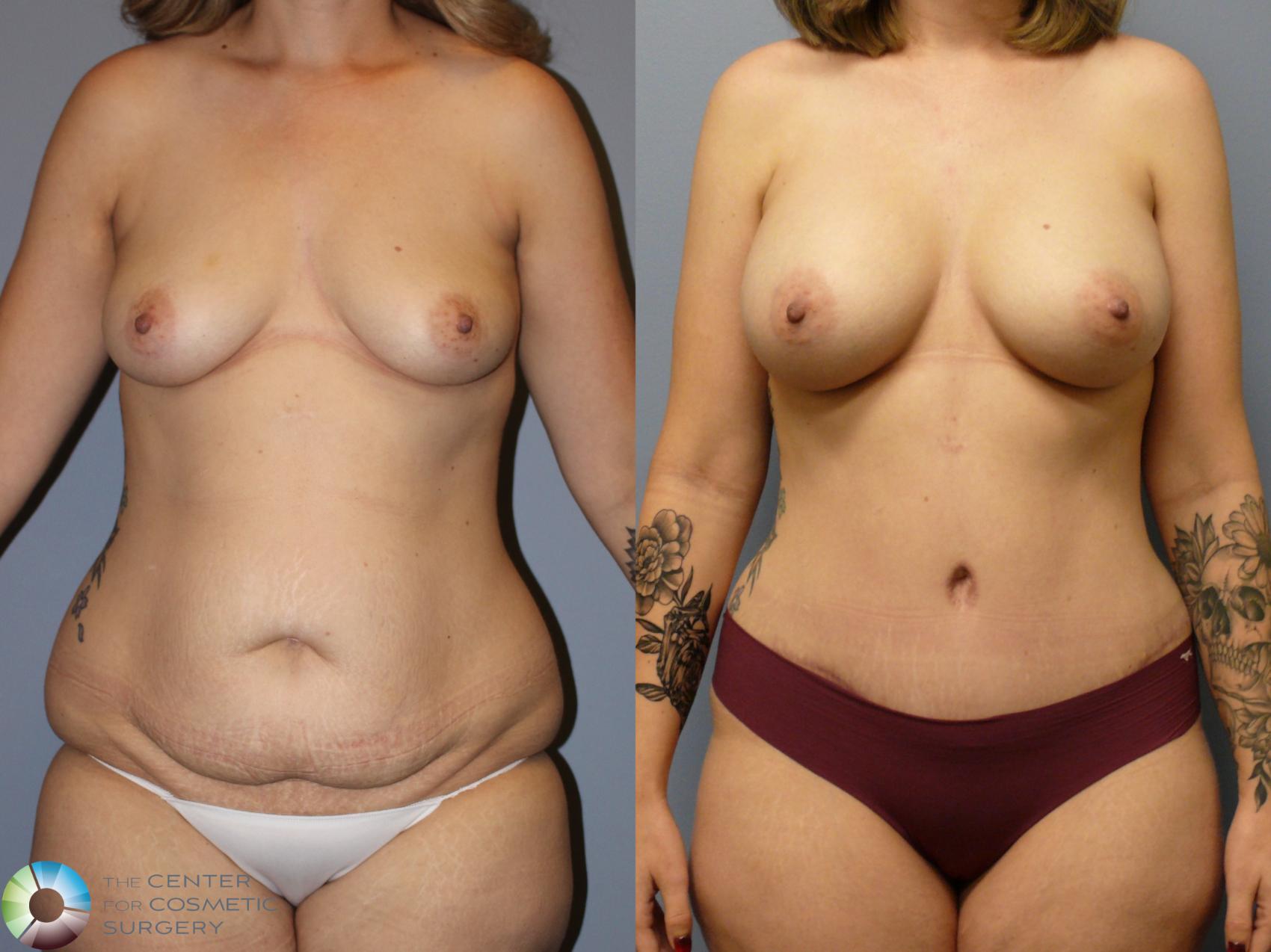 Before & After Breast Augmentation Case 11968 Front in Denver and Colorado Springs, CO