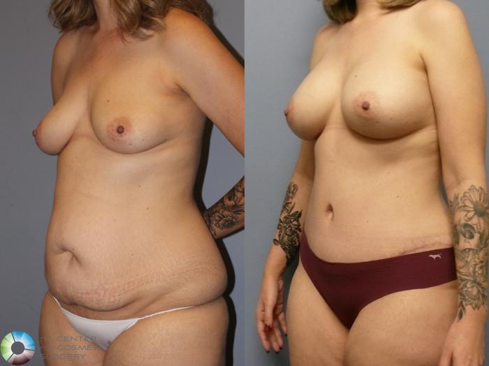 Before & After Breast Augmentation Case 11968 Left Oblique in Denver and Colorado Springs, CO