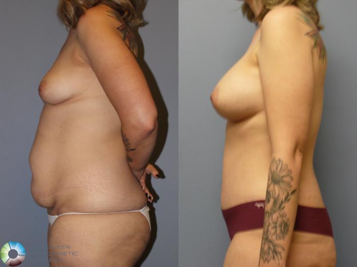 Before & After Breast Augmentation Case 11968 Left Side in Denver and Colorado Springs, CO