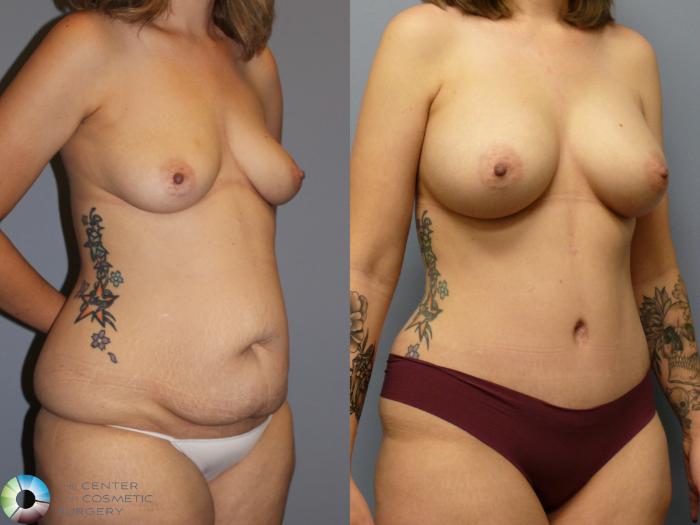 Before & After Breast Augmentation Case 11968 Right Oblique in Denver and Colorado Springs, CO