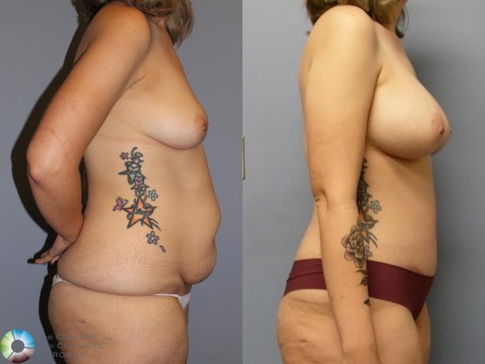 Before & After Breast Augmentation Case 11968 Right Side in Denver and Colorado Springs, CO
