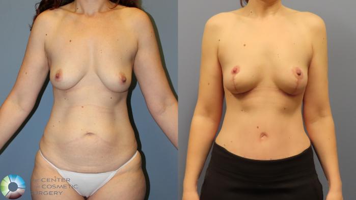 Before & After Breast Lift Case 11973 Front in Denver and Colorado Springs, CO