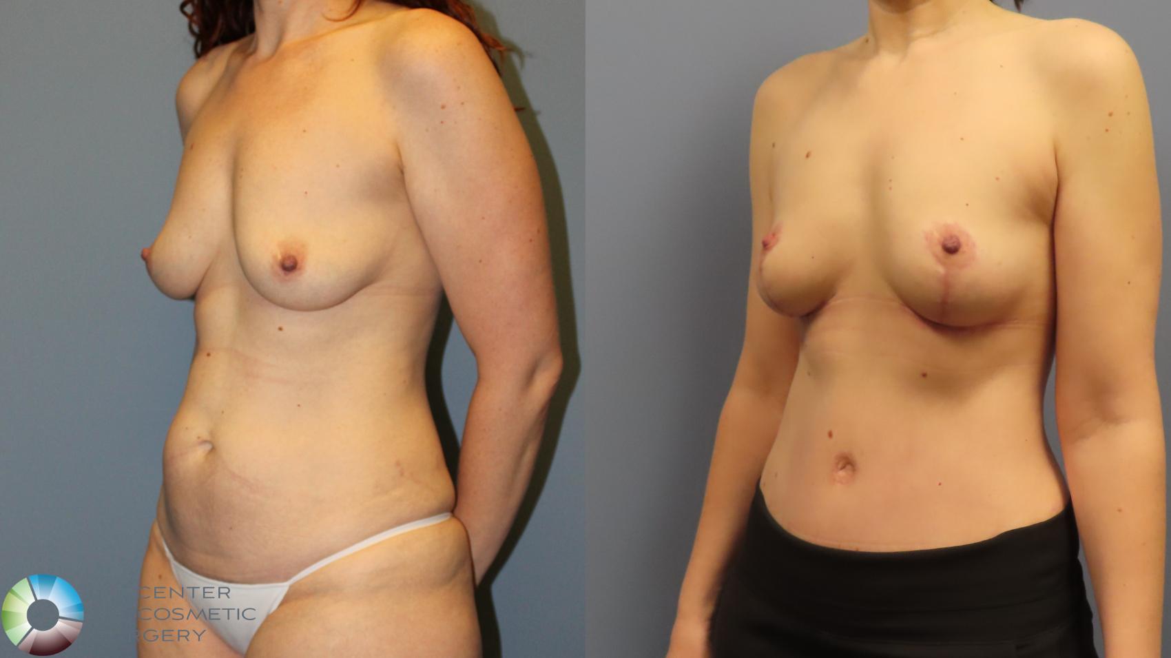 Before & After Mommy Makeover Case 11973 Left Oblique in Denver and Colorado Springs, CO