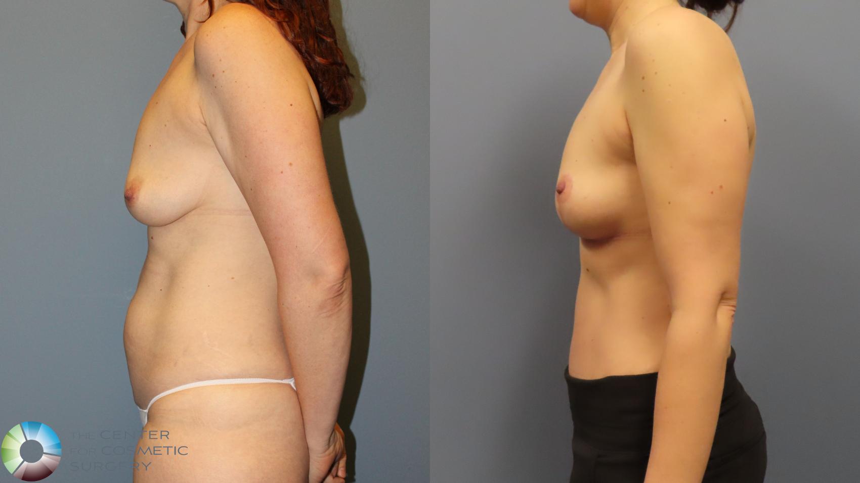Before & After Breast Lift Case 11973 Left Side in Denver and Colorado Springs, CO