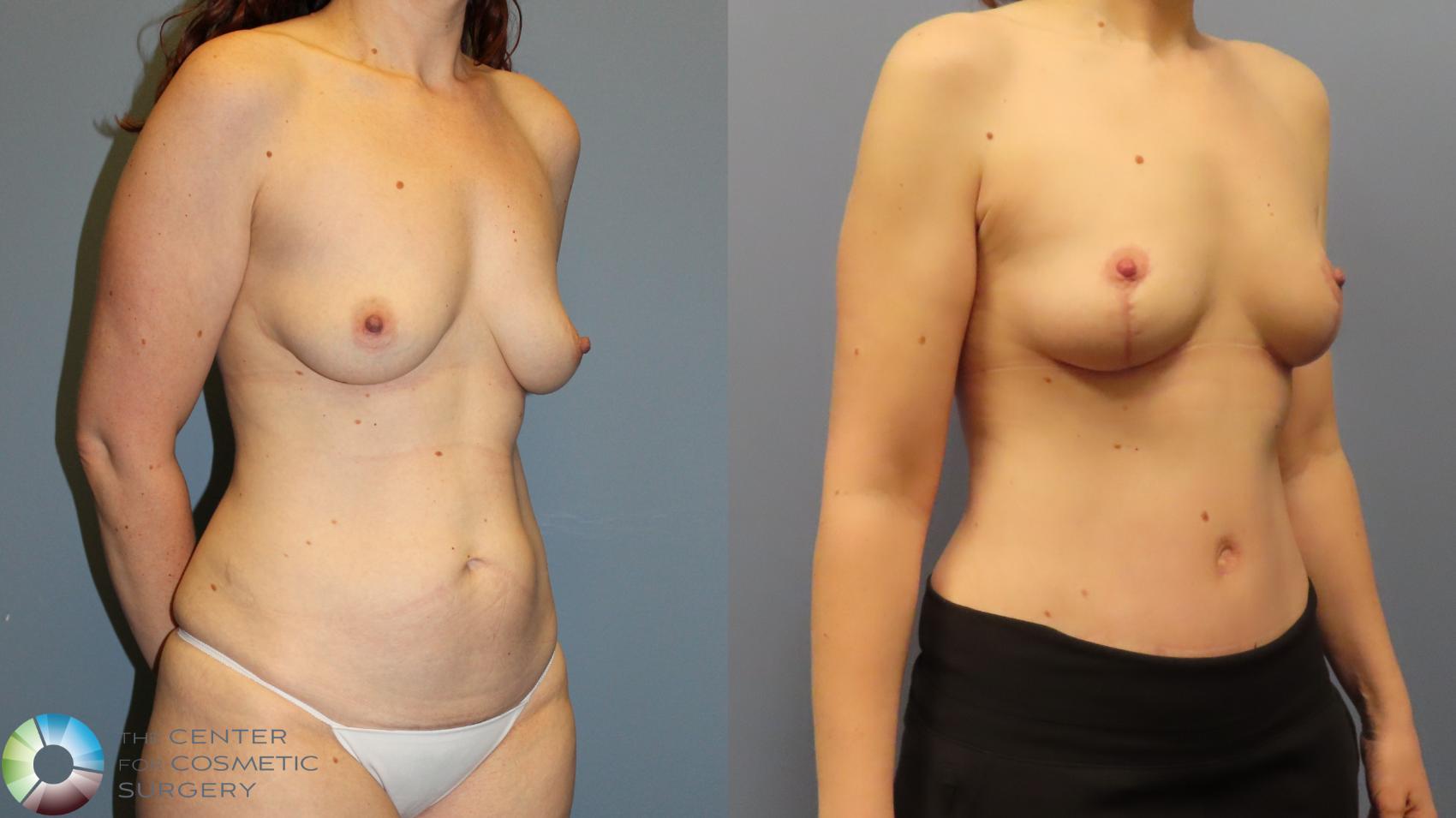 Before & After Breast Lift without Implants Case 11973 Right Oblique in Denver and Colorado Springs, CO