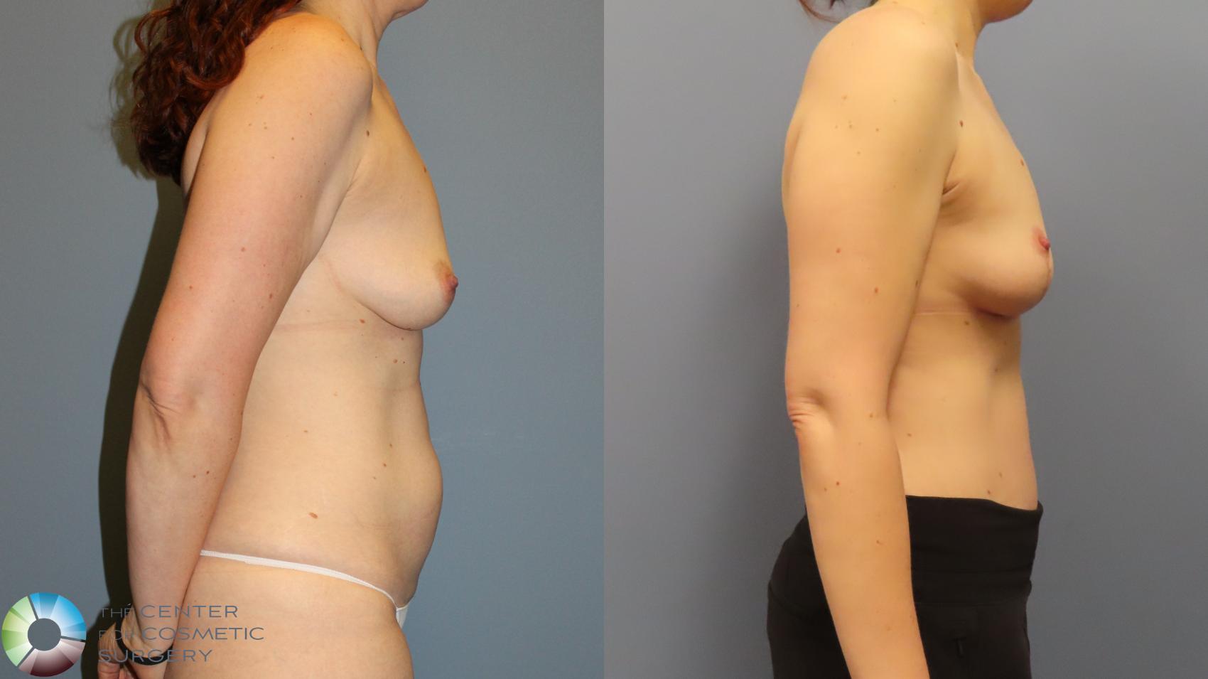 Before & After Mommy Makeover Case 11973 Right Side in Denver and Colorado Springs, CO