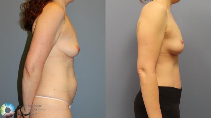 Before & After Breast Lift Case 11973 Right Side in Denver and Colorado Springs, CO