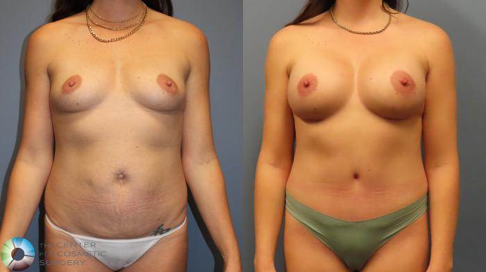 Before & After Breast Augmentation Case 11975 Front in Denver and Colorado Springs, CO