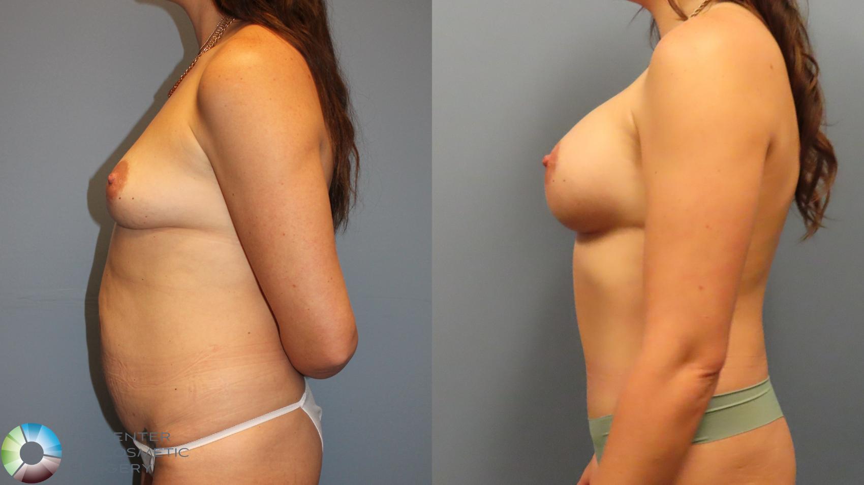 Before & After Breast Augmentation Case 11975 Left Side in Denver and Colorado Springs, CO