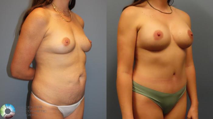 Before & After Breast Augmentation Case 11975 Right Oblique in Denver and Colorado Springs, CO