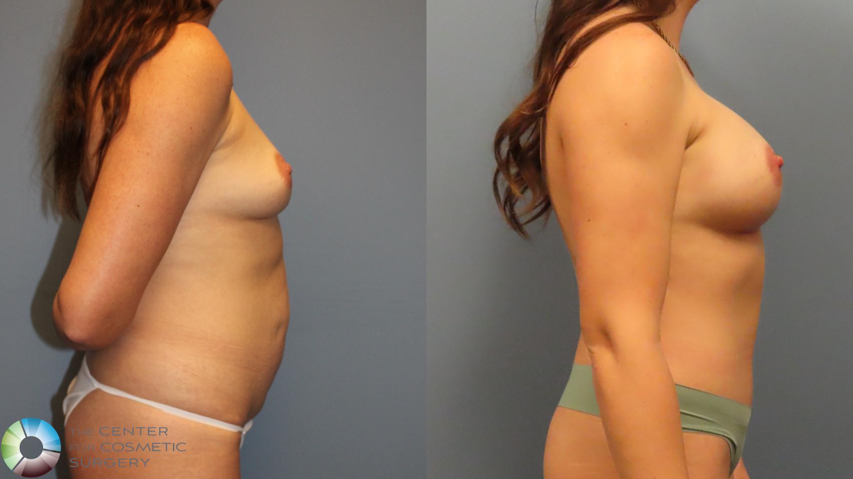 Before & After Mommy Makeover Case 11975 Right Side in Denver and Colorado Springs, CO
