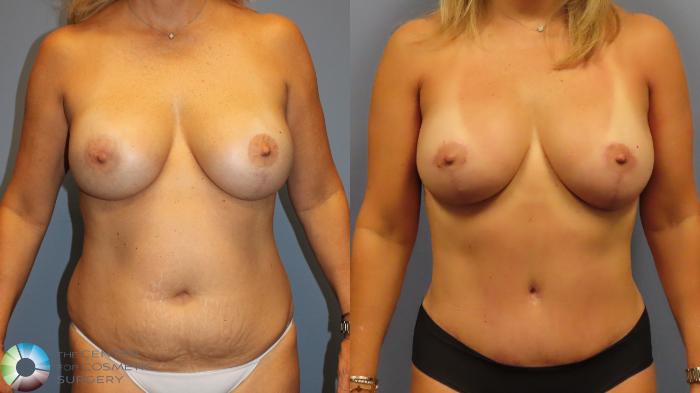 Before & After Tummy Tuck Case 11999 Front in Denver and Colorado Springs, CO