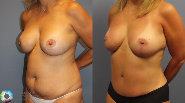 Before & After Breast Lift Case 11999 Left Oblique in Denver and Colorado Springs, CO