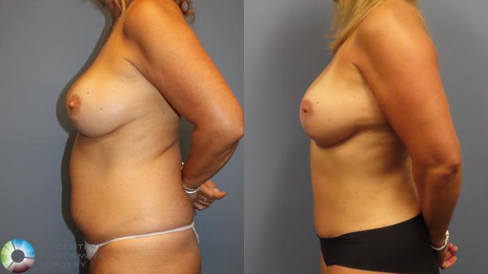 Before & After Breast Augmentation Case 11999 Left Side in Denver and Colorado Springs, CO