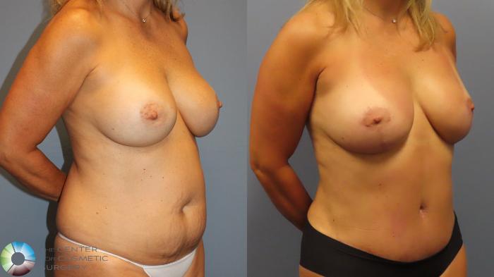 Before & After Breast Lift Case 11999 Right Oblique in Denver and Colorado Springs, CO