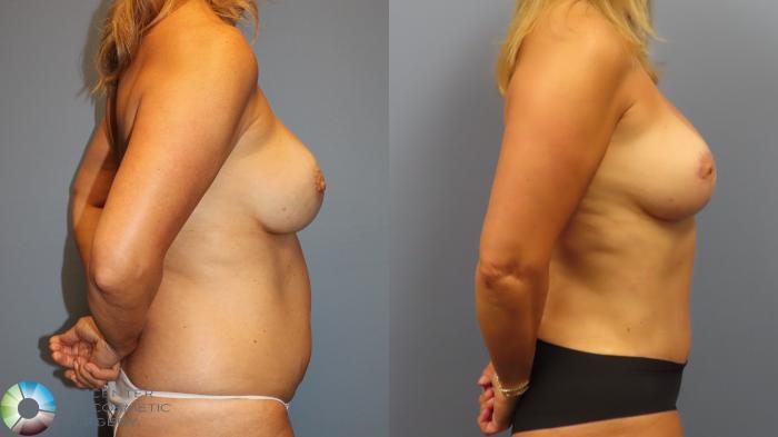 Before & After Breast Lift Case 11999 Right Side in Denver and Colorado Springs, CO