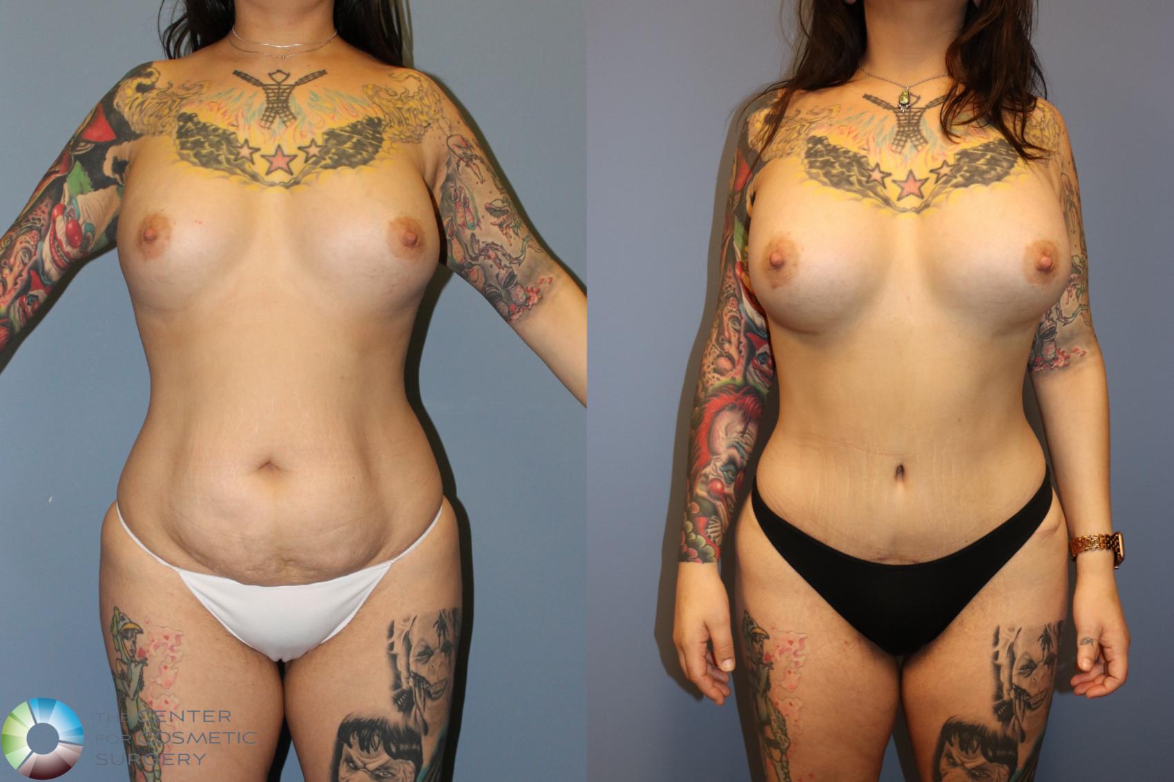 Before & After Tummy Tuck Case 12018 Front in Denver and Colorado Springs, CO