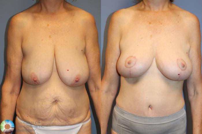 Before & After Breast Lift Case 12025 Front in Denver and Colorado Springs, CO