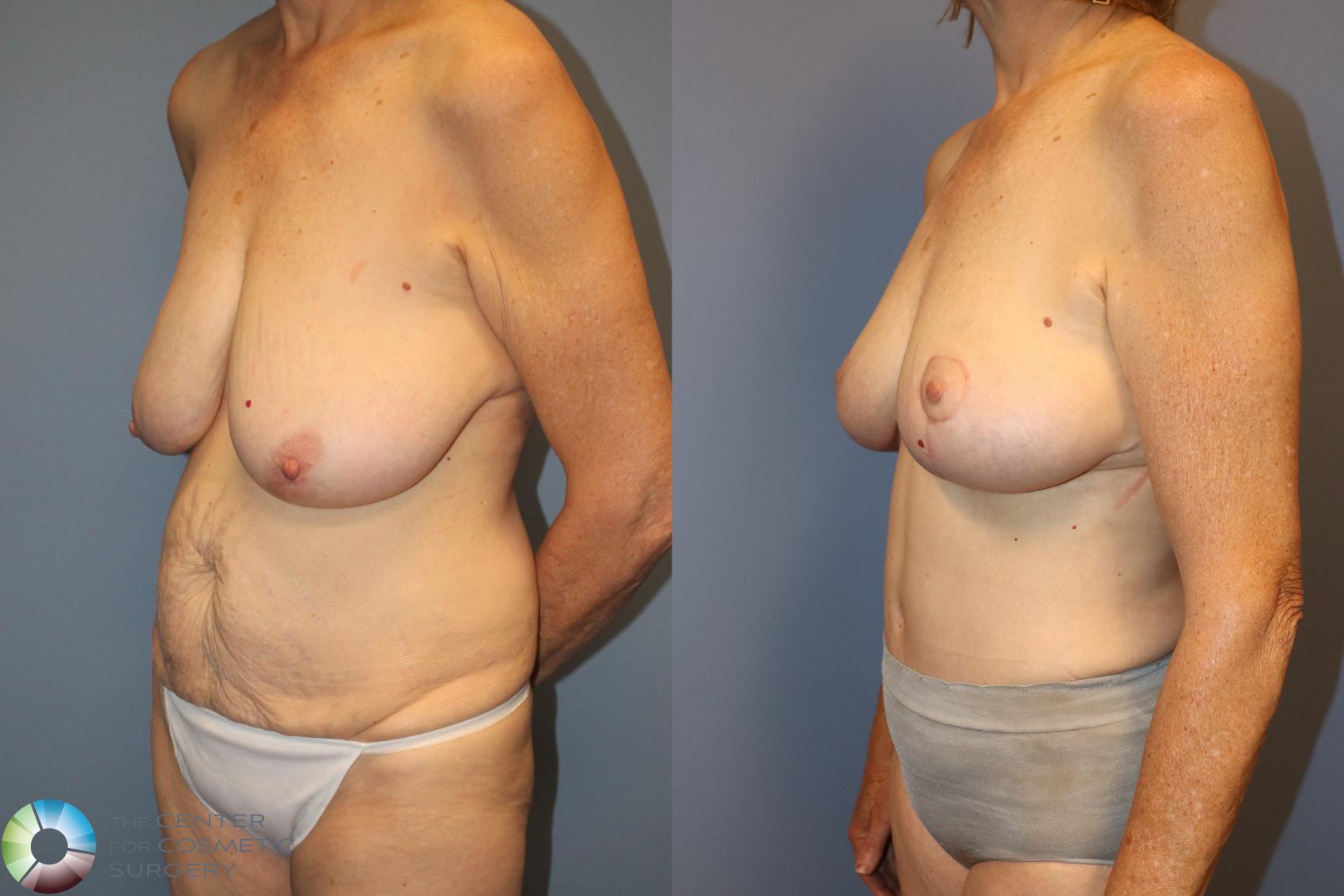 Before & After Breast Lift Case 12025 Left Oblique in Denver and Colorado Springs, CO