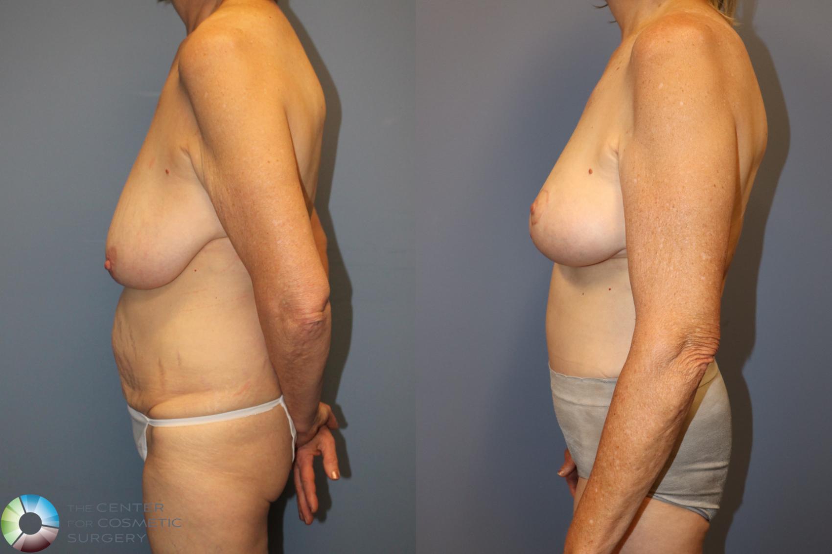 Before & After Mommy Makeover Case 12025 Left Side in Denver and Colorado Springs, CO