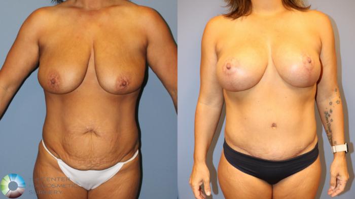 Before & After Breast Lift Case 12027 Front in Denver and Colorado Springs, CO