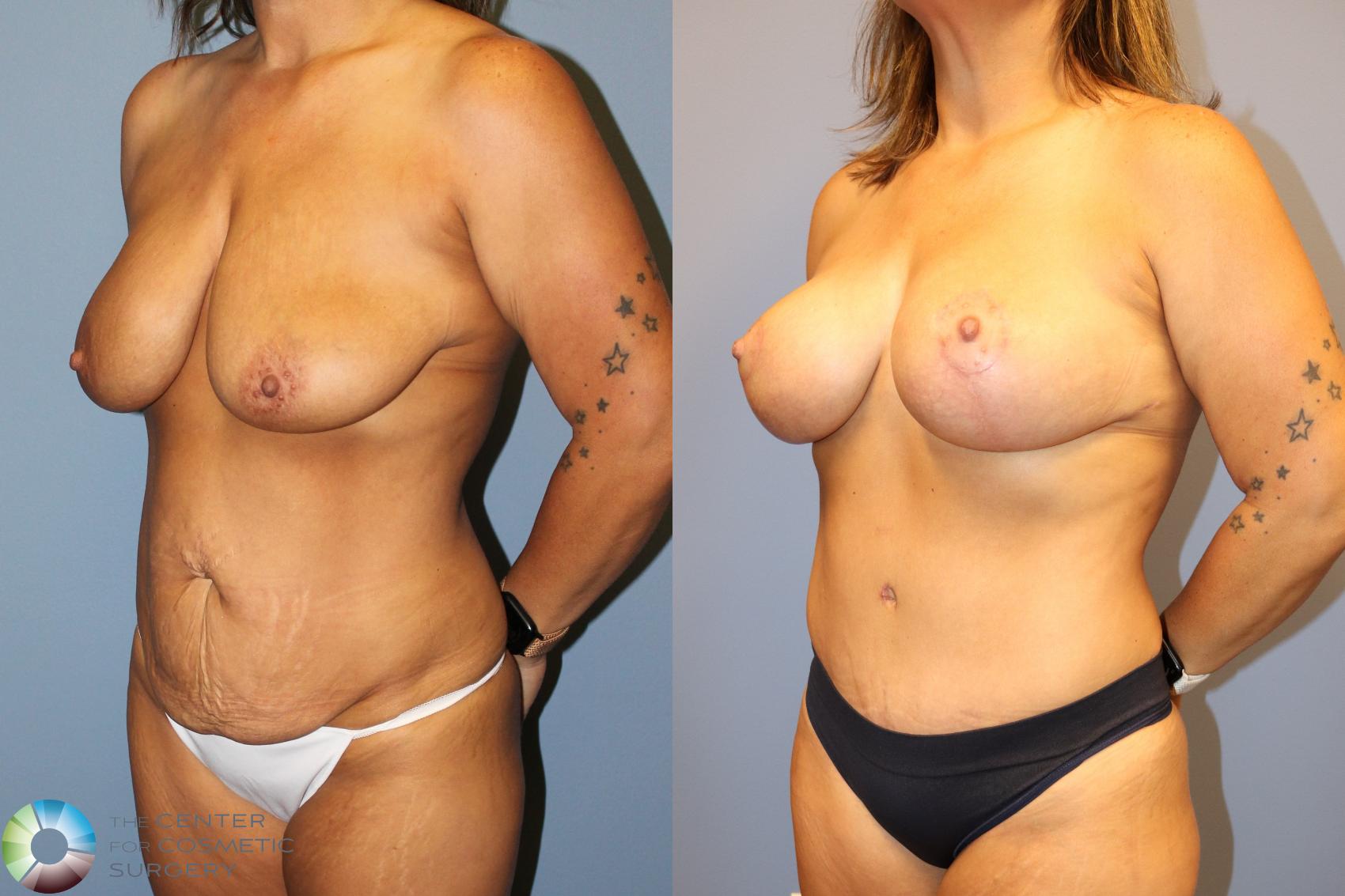 Before & After Mommy Makeover Case 12027 Left Oblique in Denver and Colorado Springs, CO