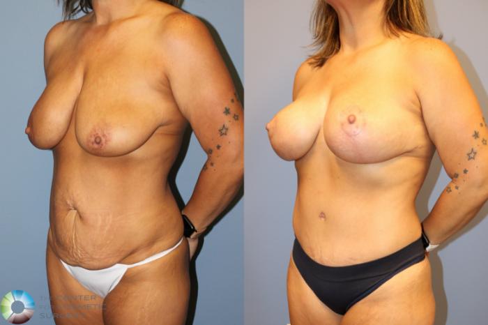 Before & After Breast Lift Case 12027 Left Oblique in Denver and Colorado Springs, CO