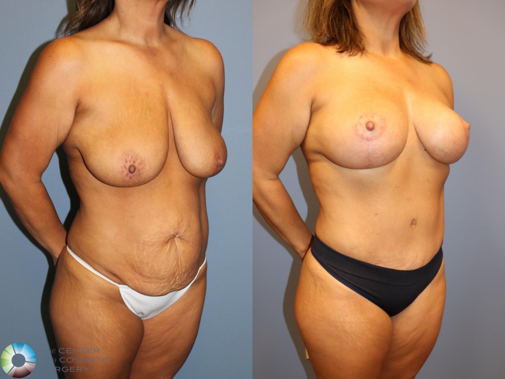 Before & After Breast Lift Case 12027 Right Oblique in Denver and Colorado Springs, CO