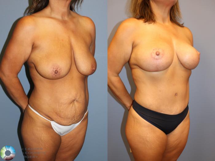 Before & After Breast Lift without Implants Case 12027 Right Oblique in Denver and Colorado Springs, CO