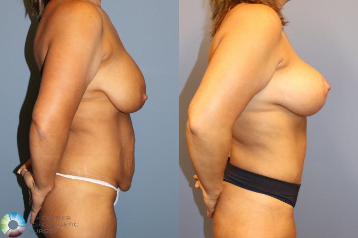 Before & After Breast Lift Case 12027 Right Side in Denver and Colorado Springs, CO