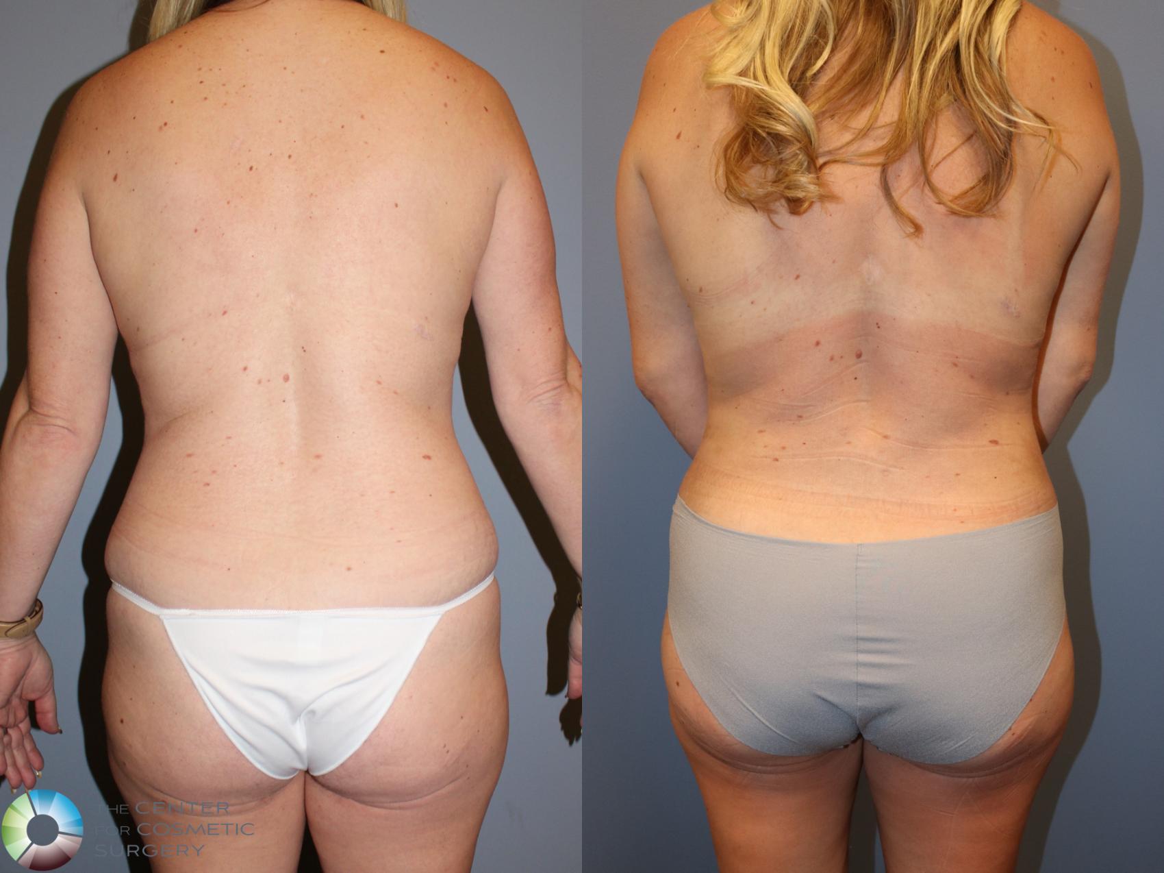 Before & After Mommy Makeover Case 12028 Back in Denver and Colorado Springs, CO