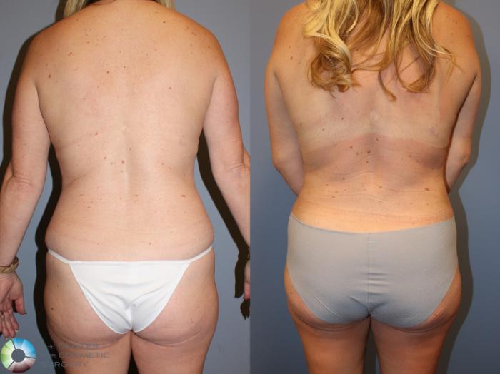 Before & After Power-Assisted Liposuction Case 12028 Back in Denver and Colorado Springs, CO