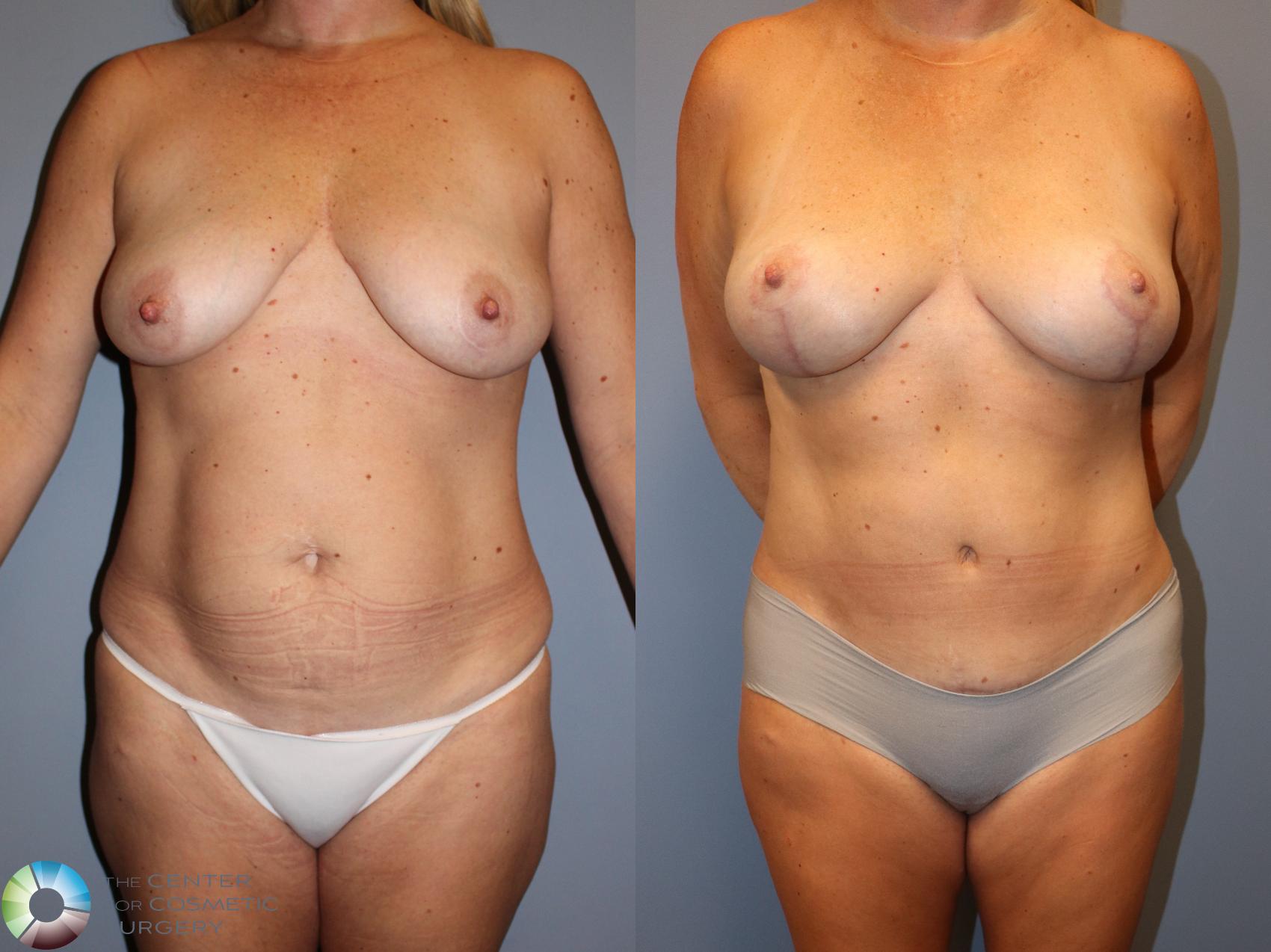 Before & After Breast Lift Case 12028 Front in Denver and Colorado Springs, CO