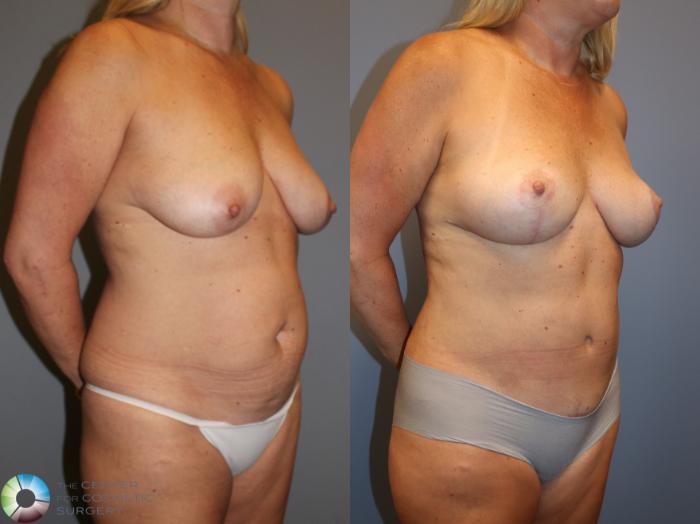 Before & After Liposuction Case 12028 Right Oblique in Denver and Colorado Springs, CO