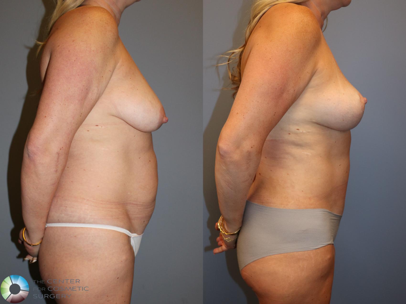 Before & After Mommy Makeover Case 12028 Right Side in Denver and Colorado Springs, CO