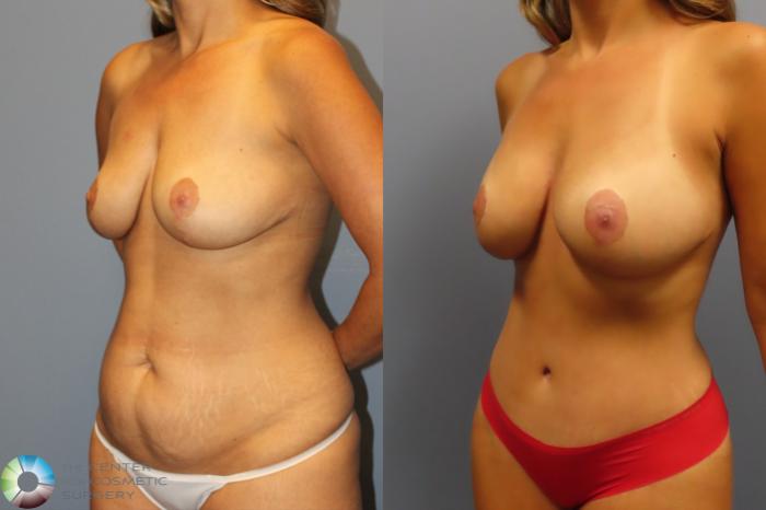 Best Denver Mommy Makeover