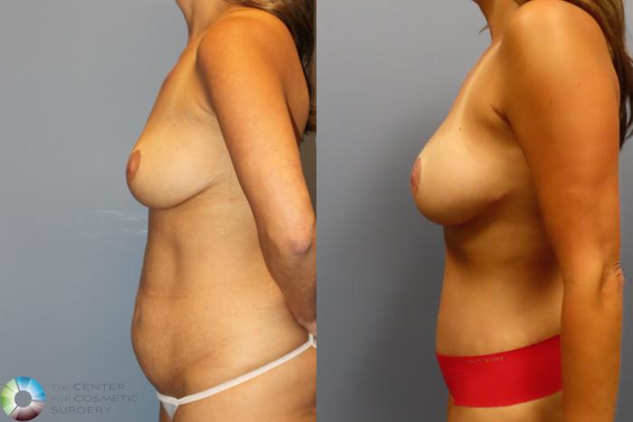 Best Denver Mommy Makeover