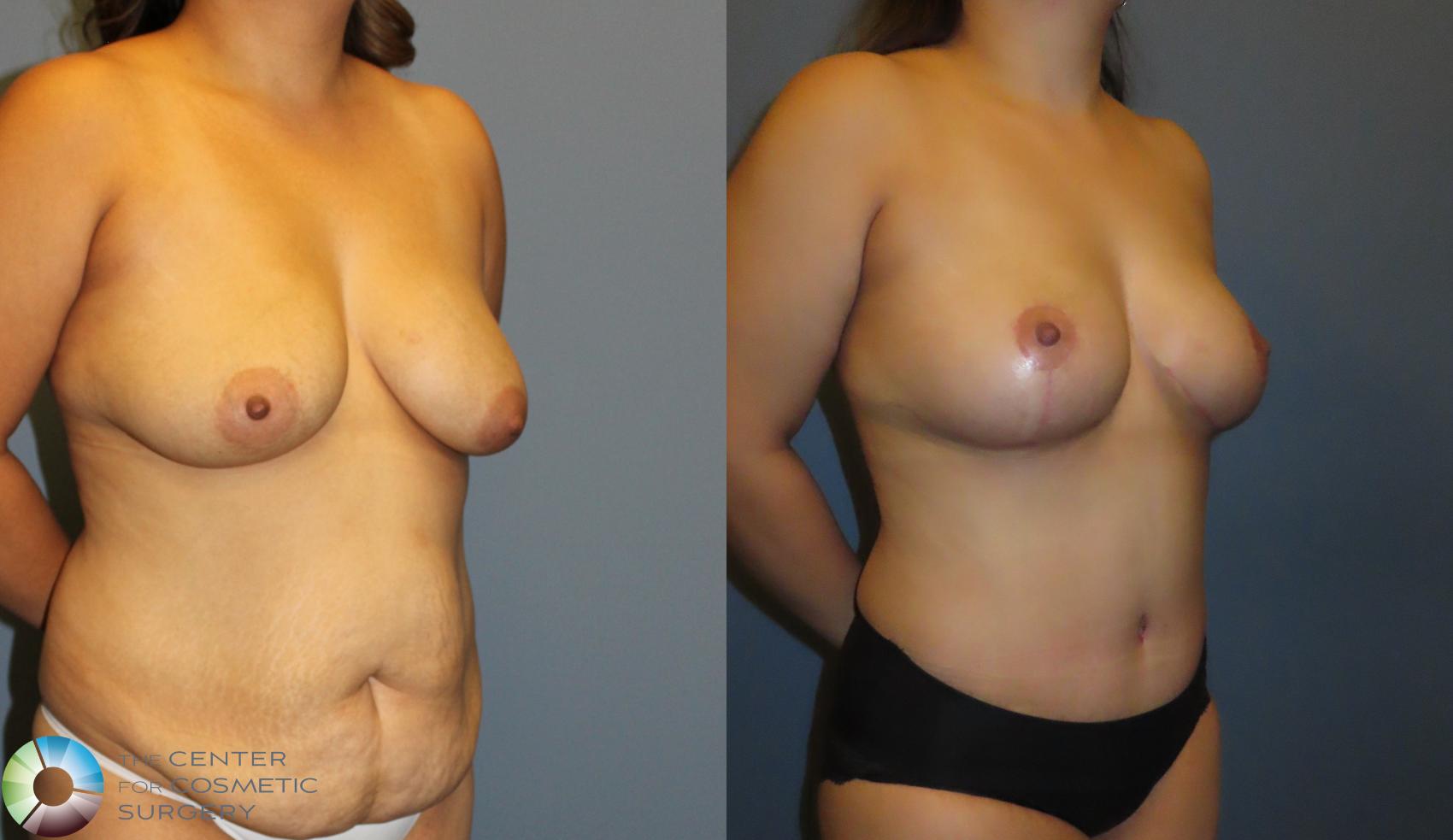 Before & After Mommy Makeover Case 12051 Right Oblique in Denver and Colorado Springs, CO