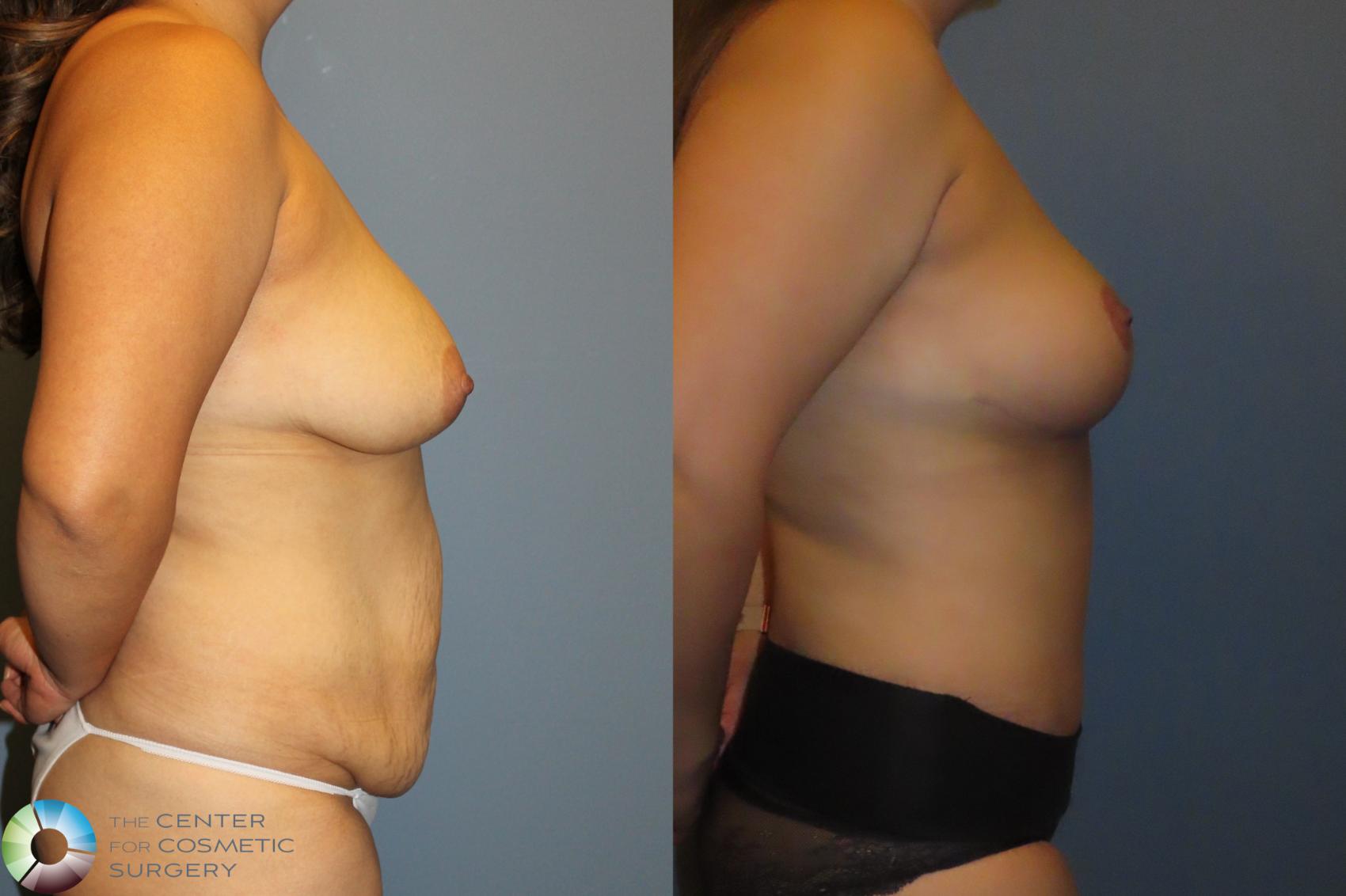 Before & After Mommy Makeover Case 12051 Right Side in Denver and Colorado Springs, CO