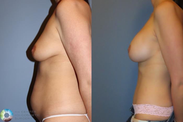 Best Denver Mommy Makeover