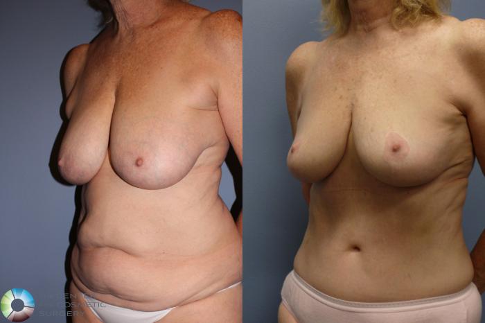Best Denver Mommy Makeover